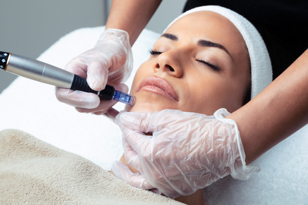 Micro Needling for acne scarring